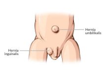 Gejala Hernia yang Sering Diabaikan dan Cara Mengenali Tanda Awalnya Gejala Hernia yang Sering Diabaikan dan Cara Mengenali Tanda Awalnya