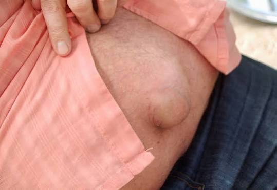 Gejala Hernia